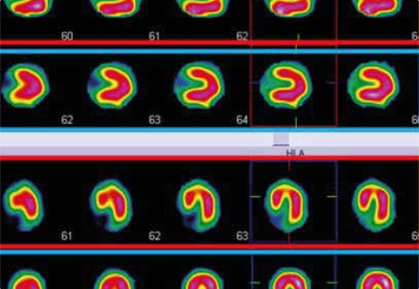 Scintigraphie myocardique